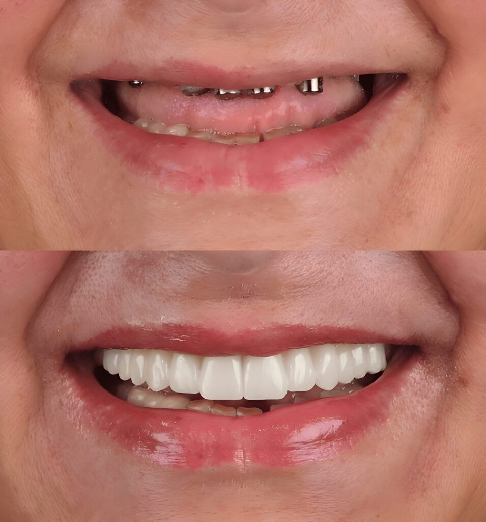 Smiling patient after dental implant treatment at CDIC Islamabad