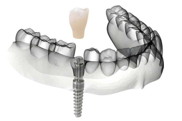 3D illustration of Immediate Load Dental Implant with same-day temporary crown placed in the jawbone at Crescent Dental & Implant Center (CDIC) Islamabad