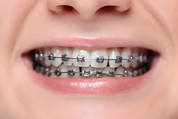 Smiling patient wearing braces during orthodontic treatment at CDIC Islamabad