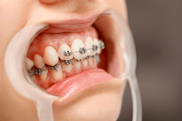 Orthodontist adjusting braces during checkup at CDIC Islamabad