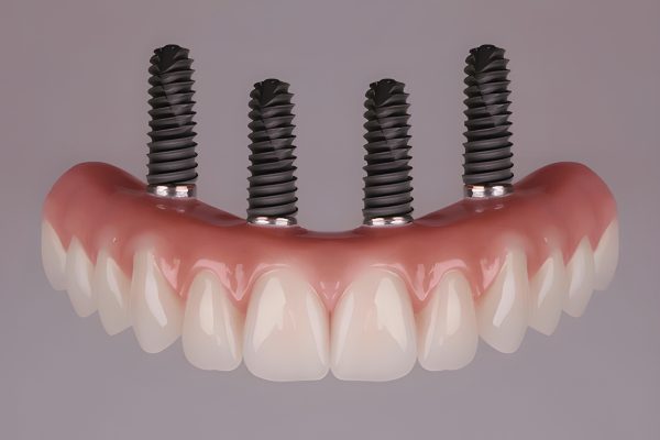 Full arch prosthesis supported by four dental implants at CDIC Islamabad