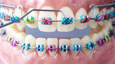 Colorful metal braces on teeth for orthodontic treatment at CDIC Islamabad orthodontics clinic.