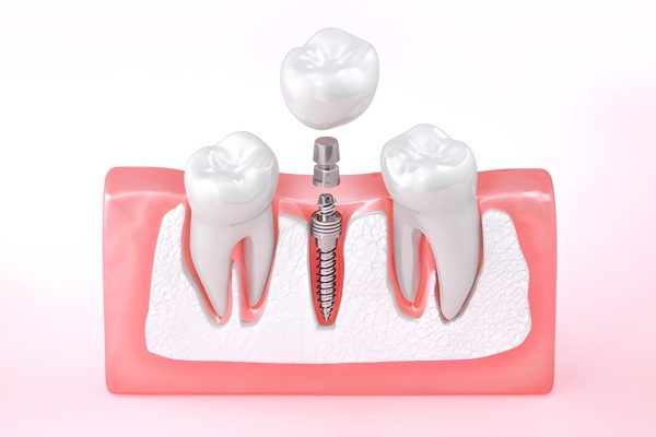 Endosteal Implant – CDIC Islamabad