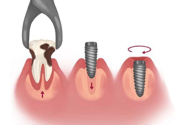 Same-day dental implant placement with immediate tooth restoration at CDIC Islamabad