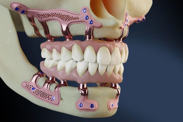 Subperiosteal implant frame for low bone height at CDIC Islamabad