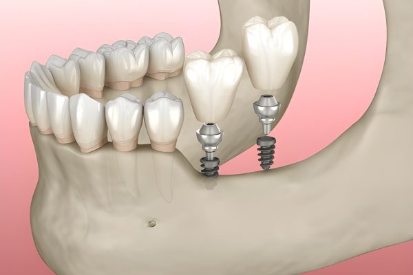 Mini dental implant comparison showing smaller implant for minimal bone support at CDIC Islamabad