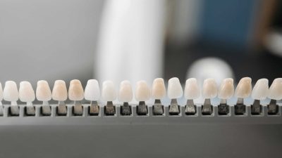 Close-up of dental veneers arranged neatly on a display rack in a dental office setting.