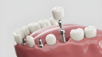 Dental implant procedure with artificial tooth placement in a patient's mouth.