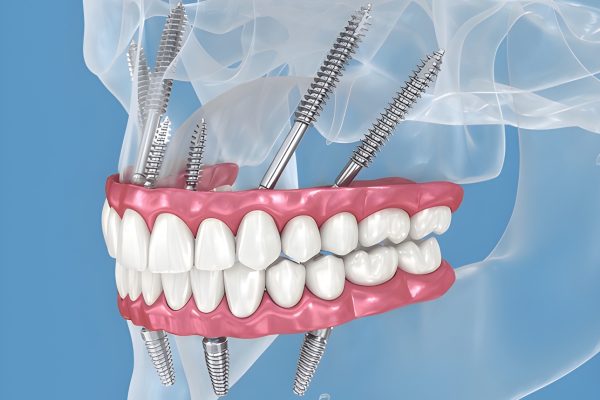 Zygomatic dental implant anchored in cheekbone for upper jaw restoration