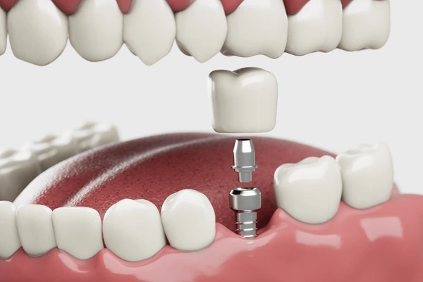 3D illustration explaining What Are Mini Dental Implants in Islamabad at CDIC showing titanium post in jawbone
