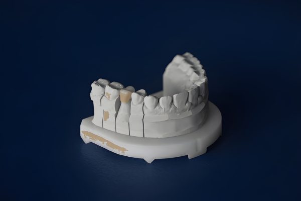 why-zirconia-crowns-important-islamabad